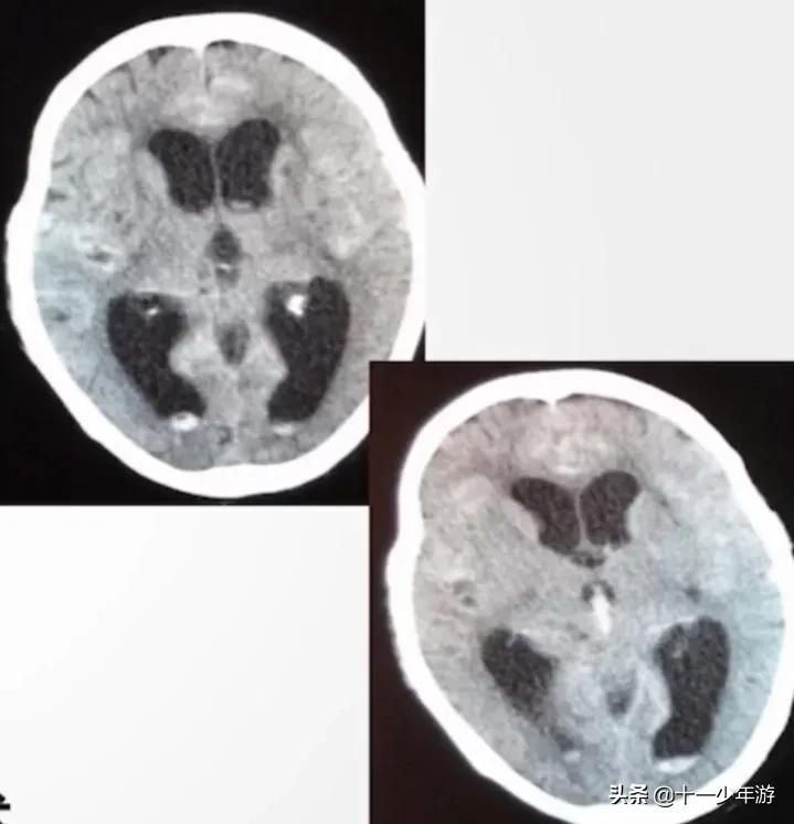 虹网膜下腔出血是什么原因{